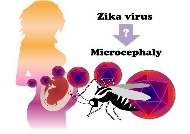 茲卡病毒(Zika virus)可能是造成小頭症(Microcephaly)的元兇，雖然目前沒有直接的證據，但種種的跡象顯示兩者存在著高度的關聯性。（圖片來源：撰稿團隊）