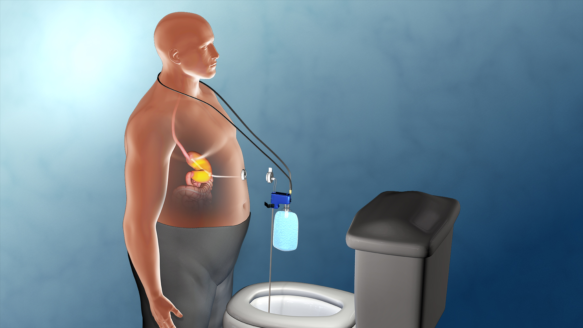 「助抽器」由體內導管及體外抽吸裝置構成。（圖／Aspire Bariatrics）
