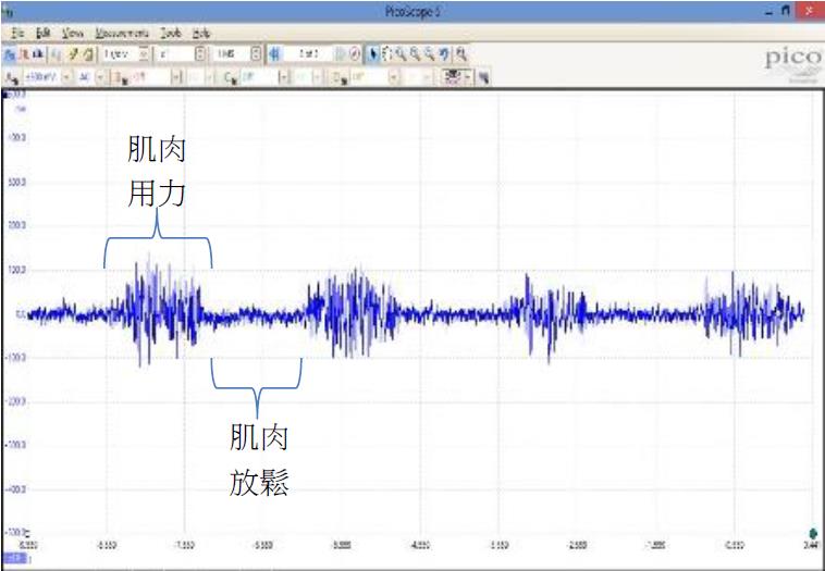 圖一：肌電訊號波形圖。感測器透過貼片接收肌電訊號，訊號處理後傳到行動裝置，行動裝置再演算處理訊號並顯示肌電波形。肌電訊號會隨著肌肉出力越大，波形振動幅度越大，放鬆時波形回到原點。肌電訊號會上下振動，因為一塊肌肉是由很多肌肉細胞所組成，一個貼片可能會收到好多不同的膜電位，導致一個貼片收到的電位會浮動。（圖片來源：國立中山大學-嵌入式系統實驗室）