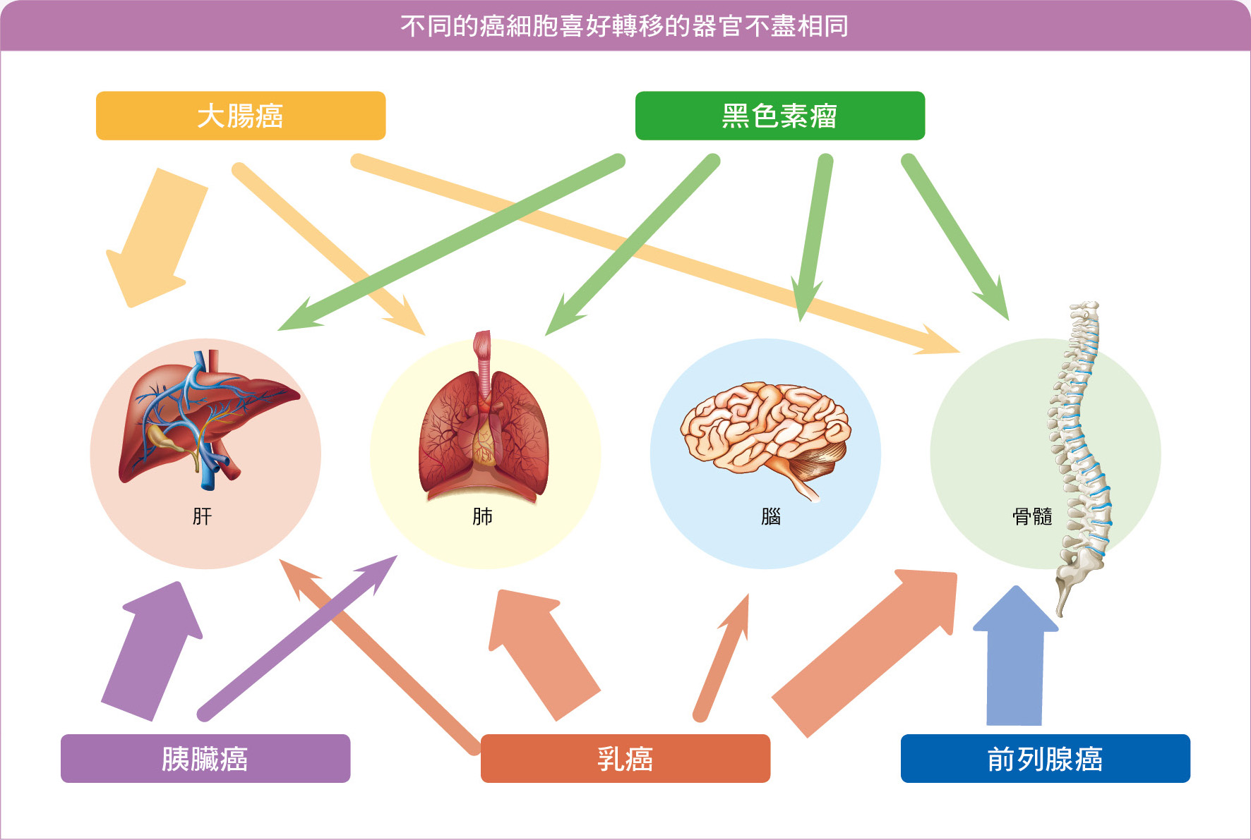 不同的癌細胞喜好轉移的器官不盡相同
