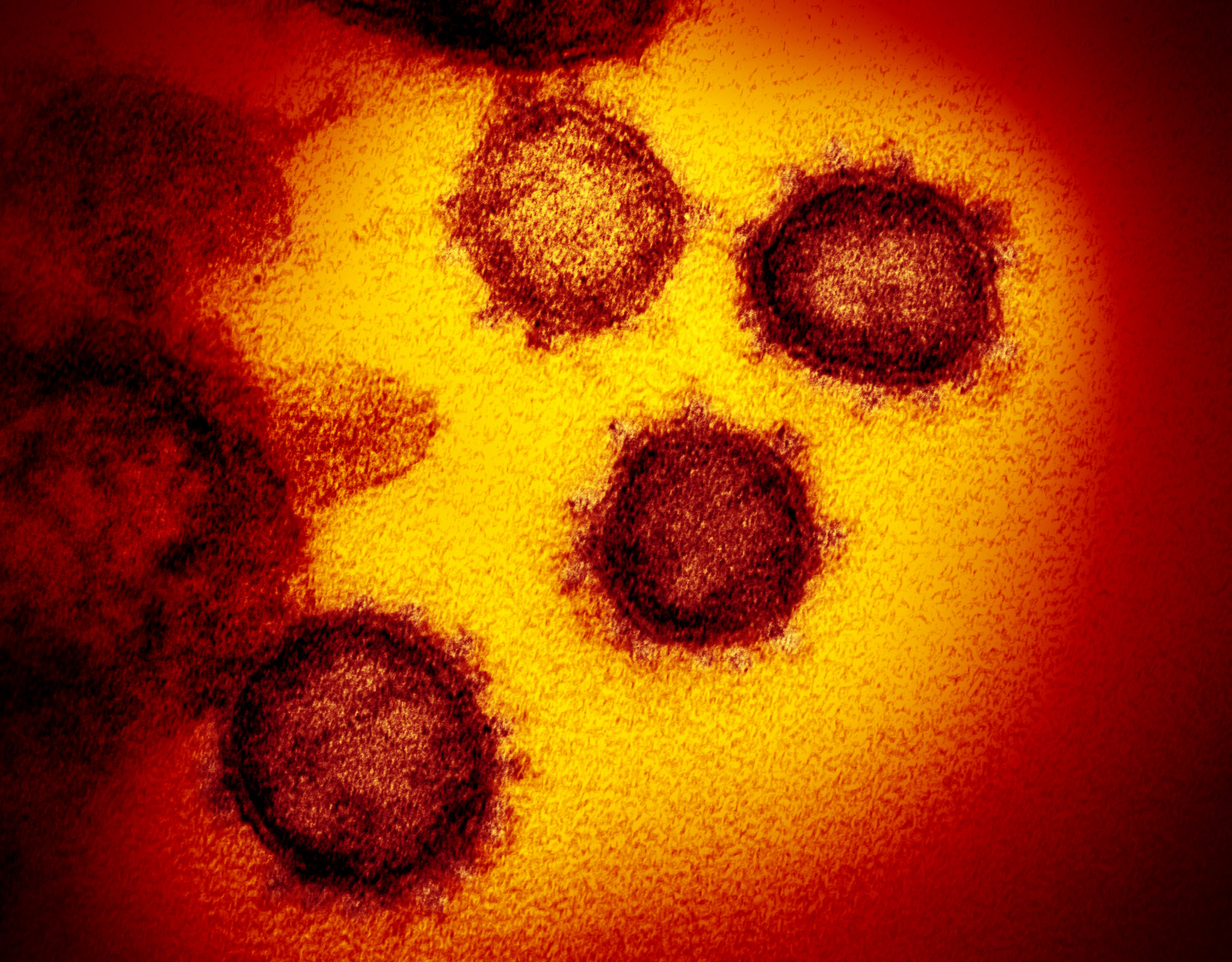 造成COVID-19的新型冠狀病毒（SARS-CoV-2）。圖為穿透式電子顯微鏡(transmission electron microscopy, TEM)取相，並經過數位上色。（圖／NIAID-RML，Flickr）
