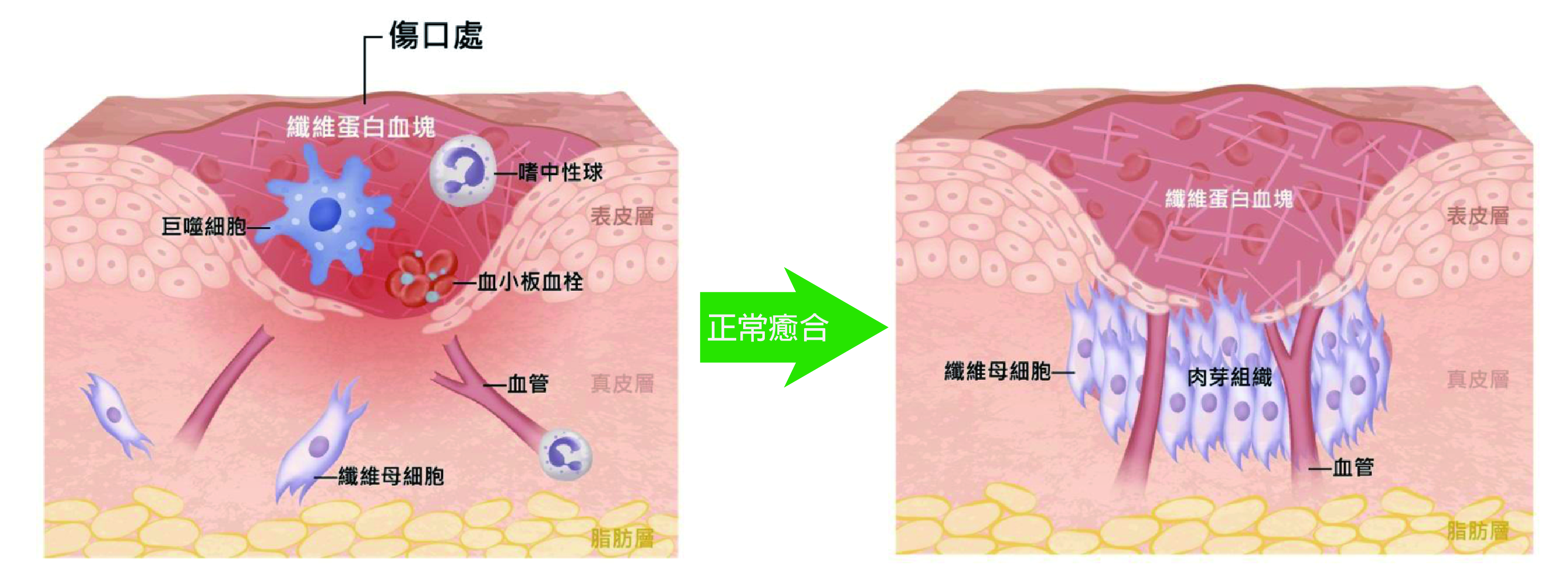 正常的傷口癒合狀態，血小板和纖維蛋白血塊不僅會先為傷口止血，還能產生暫時性組織，幫助製造膠原蛋白的纖維母細胞移動到傷口周圍。（圖／國立科學工藝博物館提供）