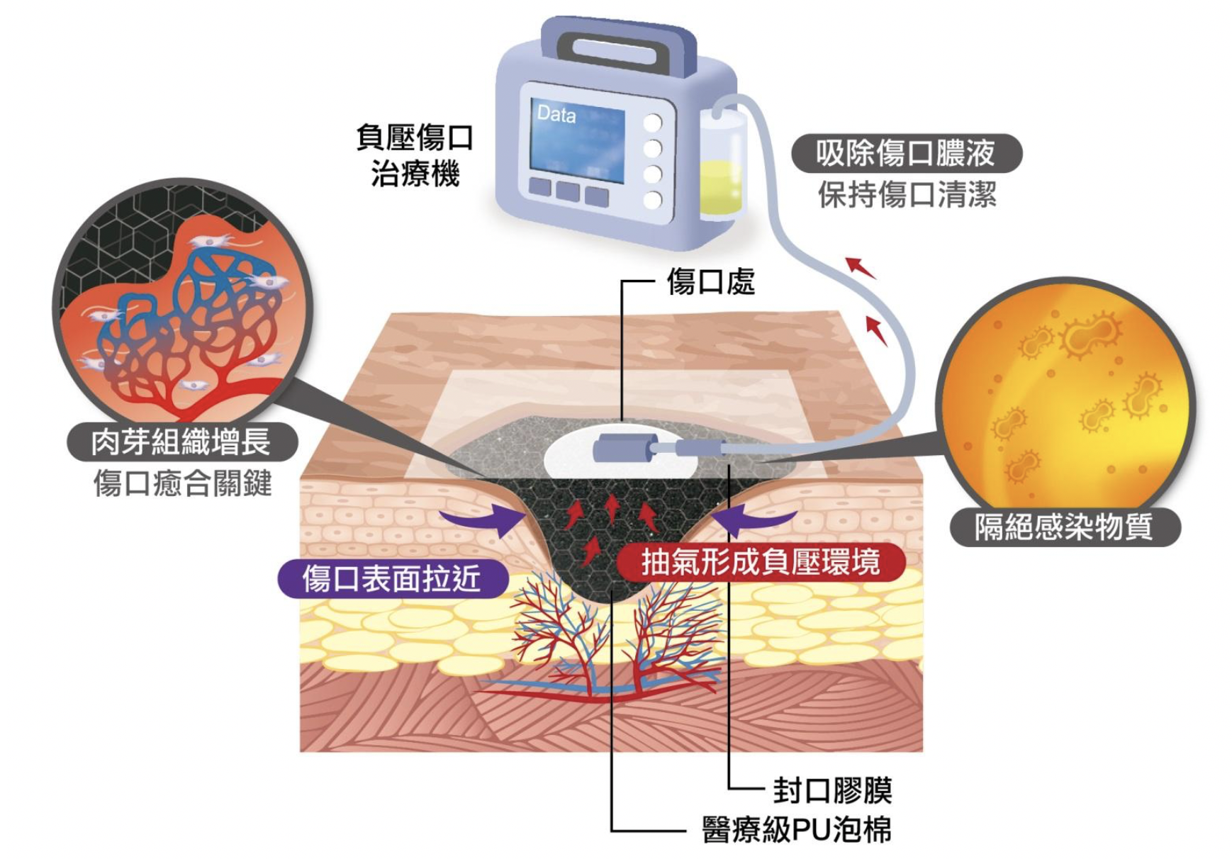 負壓療法藉由真空幫浦抽吸，促進血液循環，提高肉芽組織生成速度，同時幫助傷口排出膿液與組織液，有助傷口癒合。（圖／國立科學工藝博物館提供）