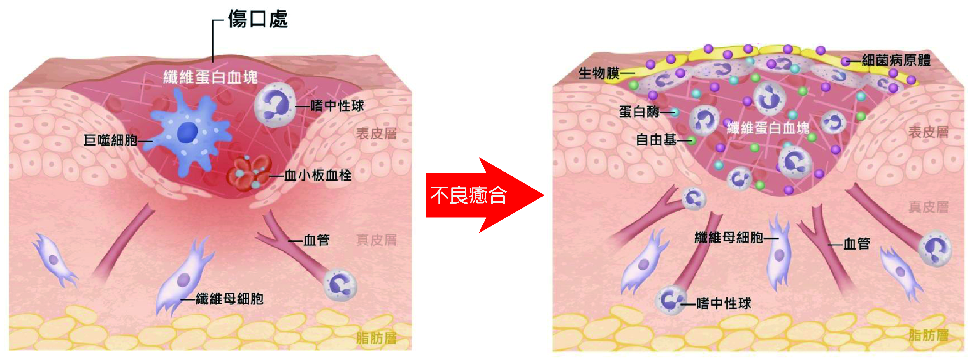 癒合不良代表傷口長期處在發炎狀態，表面形成生物膜與細菌病原體，使受損組織無法獲取足夠養分與氧氣，減緩癒合速度。（圖／國立科學工藝博物館提供）