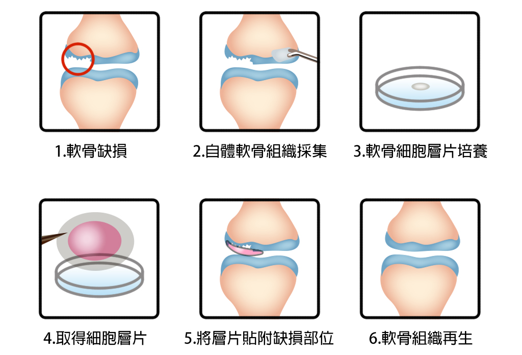細胞層片的技術簡易運用過程；針對軟骨缺損的治療，先取得自體細胞，在實驗室進行軟骨細胞層片培養，再將細胞層片放置在缺損處，能使組織順利再生。（圖／義守大學ISU科轉團隊繪製）